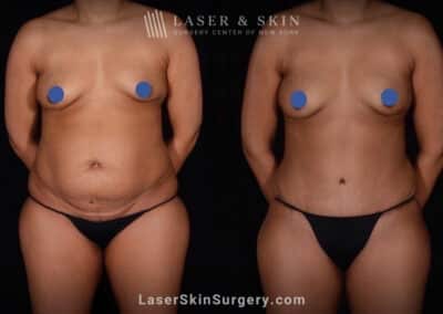 Abdominoplasty and Liposuction to Contour the Abdomen