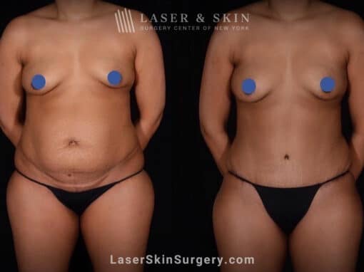 Abdominoplasty and Liposuction to Contour the Abdomen