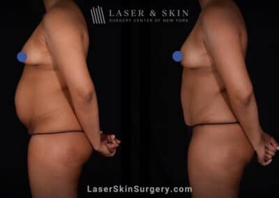 Abdominoplasty and Liposuction to Contour the Abdomen