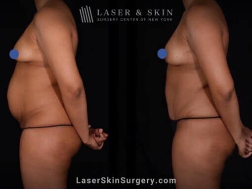 Abdominoplasty and Liposuction to Contour the Abdomen