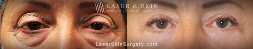 laser and skin surgery center of new york blepharoplasty before and after photo new york ny