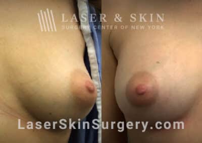 Breast Augmentation to Reshape the Breasts