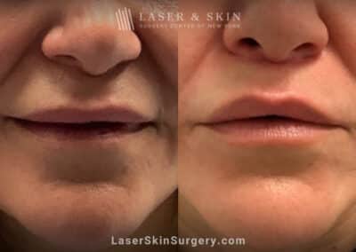 Lip Lift for to Enhance the Upper and Lower Lips