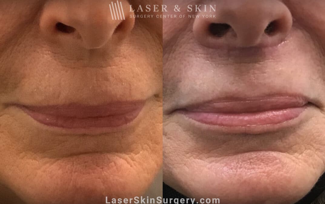 Lip Lift for to Enhance the Upper and Lower Lips