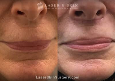 Lip Lift for to Enhance the Upper and Lower Lips