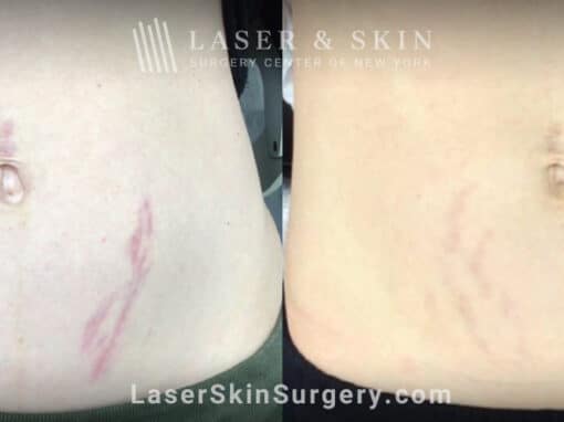 Pulsed dye laser to remove stretch marks from the abdomen