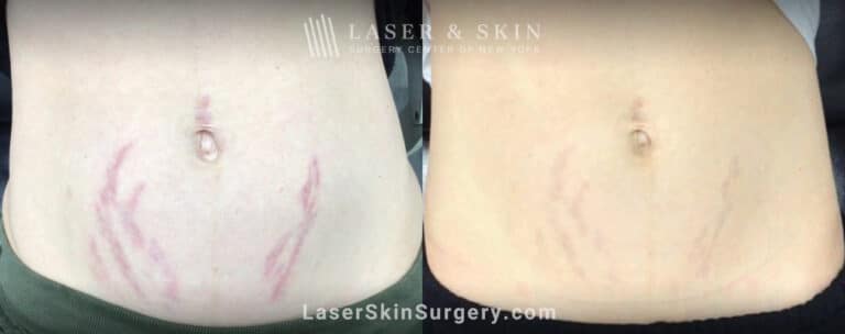 Pulsed dye laser to remove stretch marks from the abdomen