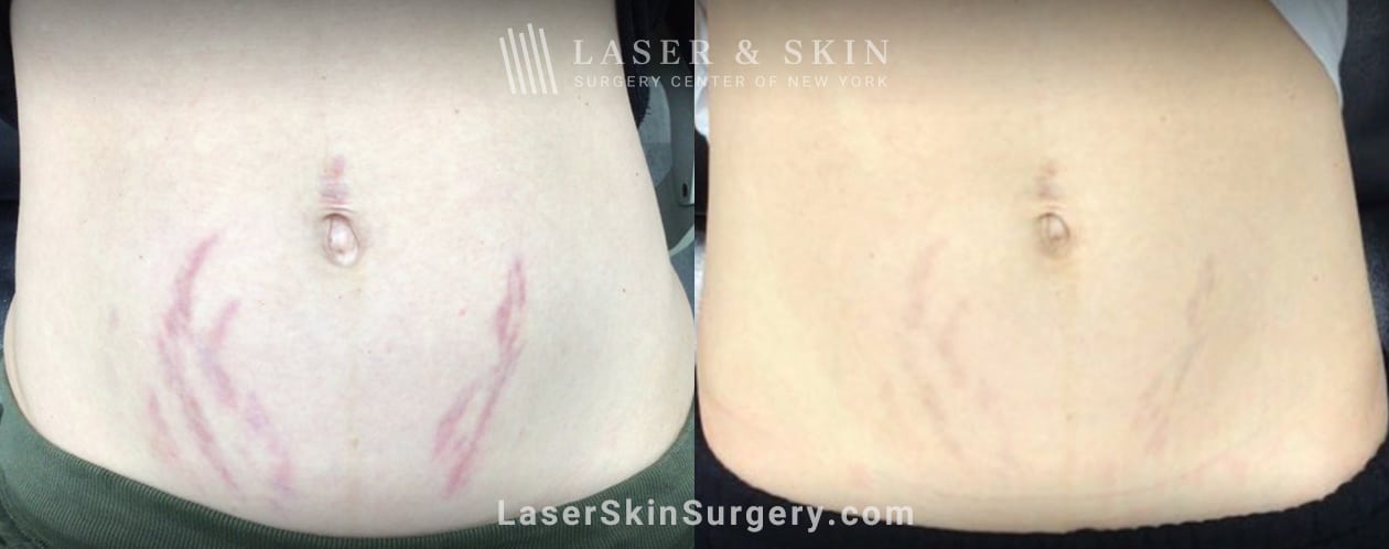 lsscny-nyc-pulsed-dye-laser-remove-stretch-marks laser stretch mark removal before and after