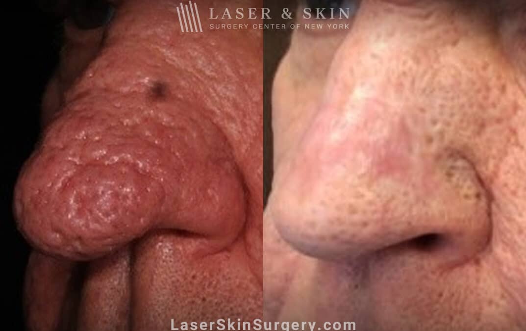 Radiofrequency treatment for rhinophyma