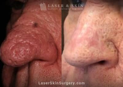 Radiofrequency treatment for rhinophyma