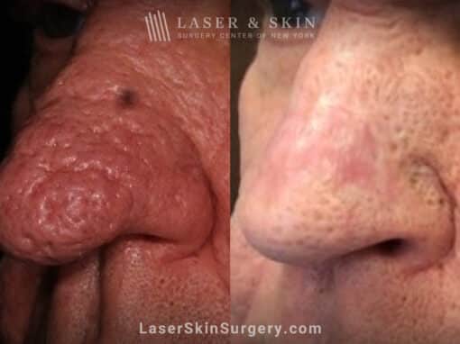 Radiofrequency treatment for rhinophyma