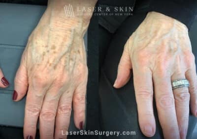 Ruby laser to rejuvenate the hands