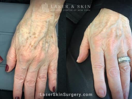 Ruby laser to rejuvenate the hands