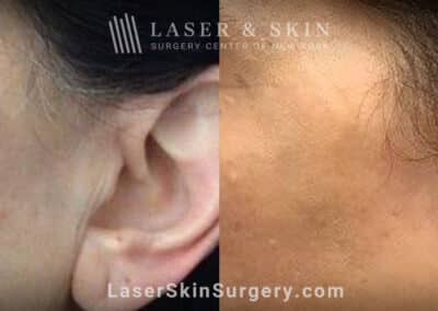 Ruby laser to treat brown spots on the cheek