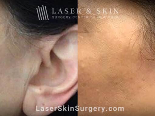 Ruby laser to treat brown spots on the cheek