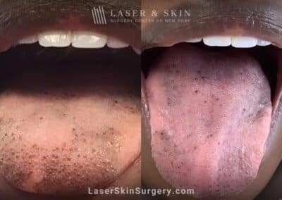 Ruby laser to remove tongue pigment
