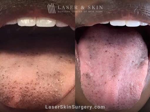 Ruby laser to remove tongue pigment