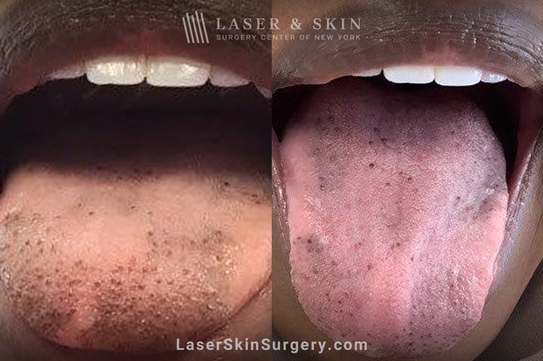 lsscny-nyc-ruby-laser-tongue-pigment-removal acne treatment before and after in new york