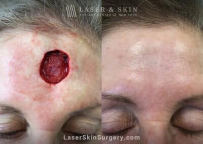 Mohs surgery to treat skin cancer on the forehead