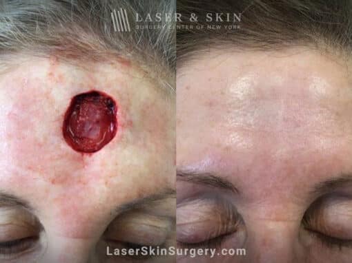 Mohs surgery to treat skin cancer on the forehead