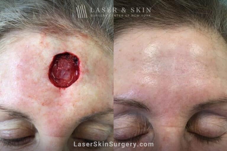 Mohs surgery to treat skin cancer on the forehead