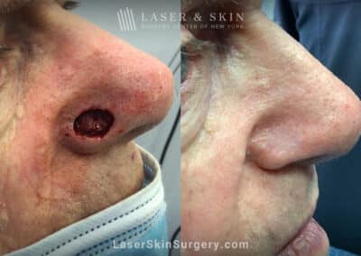 Mohs surgery to treat skin cancer on the nose