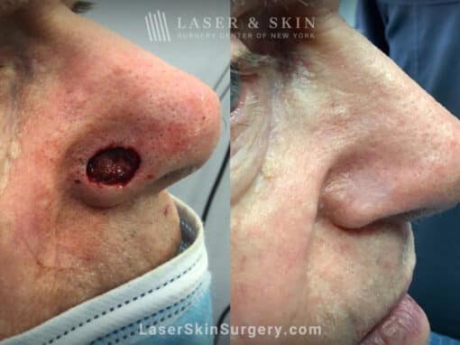 Mohs surgery to treat skin cancer on the nose