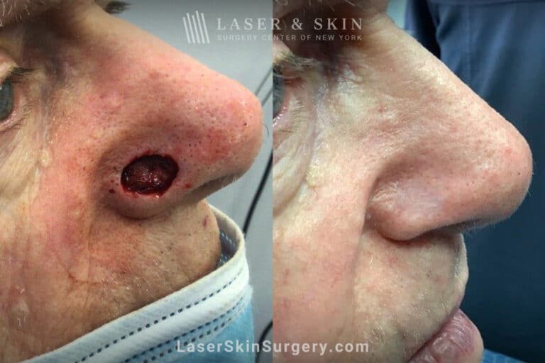 Mohs surgery to treat skin cancer on the nose