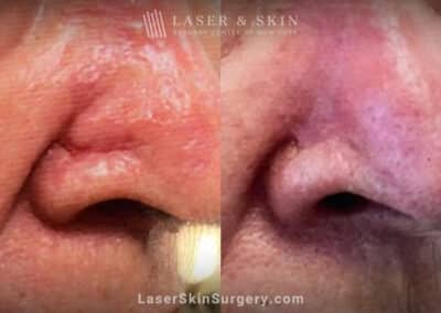 Mohs Surgery and Skin Graft to Treat Cancer on the Nose