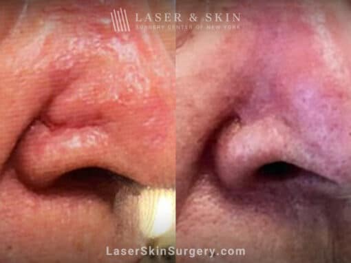 Mohs Surgery and Skin Graft to Treat Cancer on the Nose