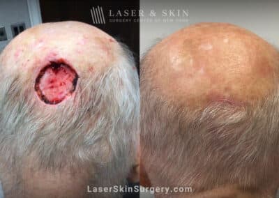 Mohs surgery and repair to treat skin cancer on the scalp