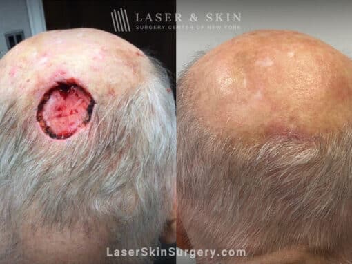 Mohs surgery and repair to treat skin cancer on the scalp