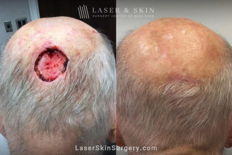 Mohs surgery and repair to treat skin cancer on the scalp