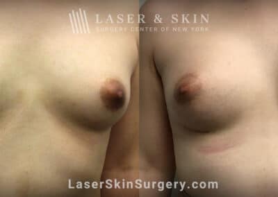Breast Augmentation to Enhance the Breasts