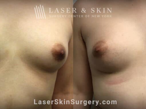 Breast Augmentation to Enhance the Breasts