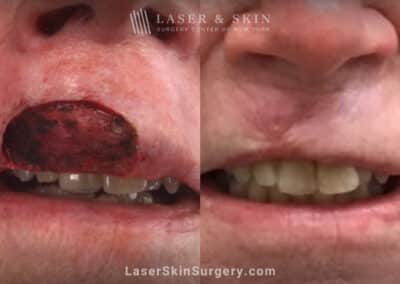 Mohs Surgery to Remove Skin Cancer on the Upper Lip