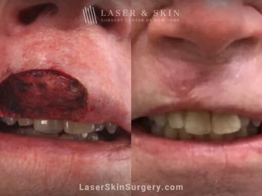 Mohs Surgery to Remove Skin Cancer on the Upper Lip