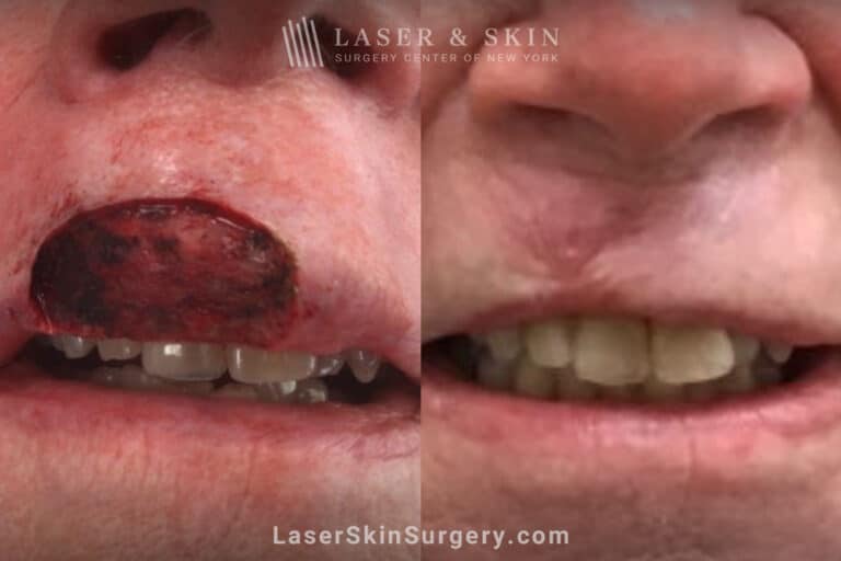 Mohs Surgery to Remove Skin Cancer on the Upper Lip