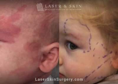 Laser treatment to remove port wine birthmark from child’s face