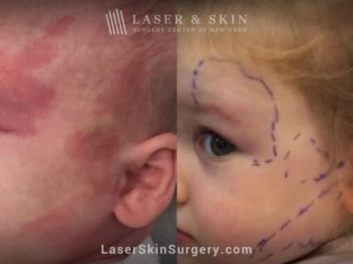 Laser treatment to remove port wine stain from child’s face