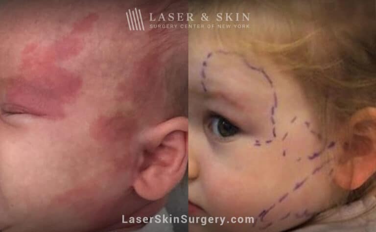 Laser treatment to remove port wine stain from child’s face