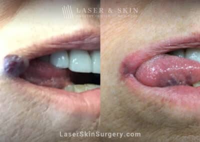 Excel V treatment to remove venous malformation from the lip