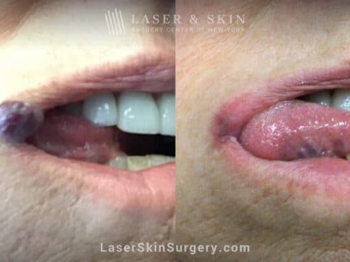 Excel V treatment to remove venous malformation from the lip