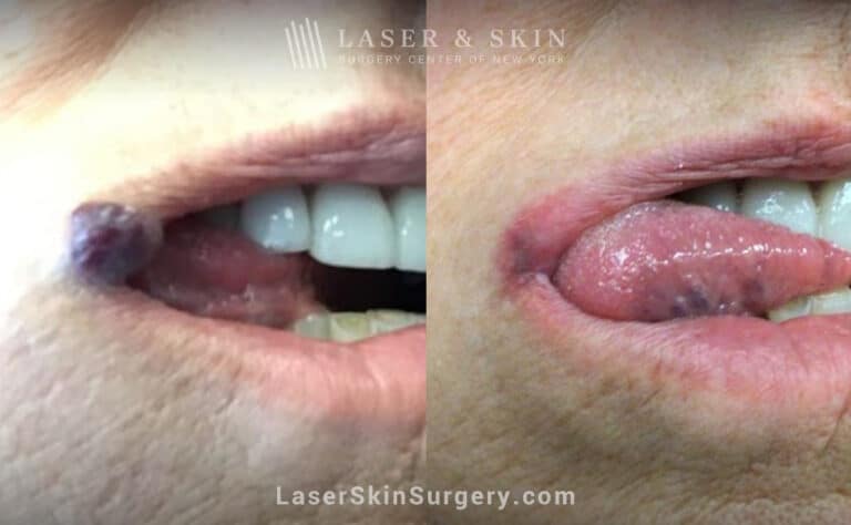 Excel V treatment to remove venous malformation from the lip