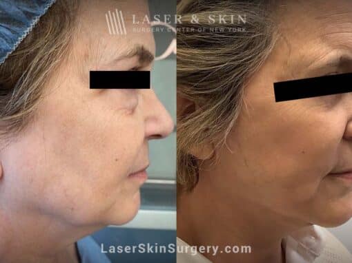 Facelift to rejuvenate the face