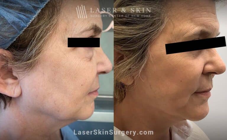 Facelift to rejuvenate the face