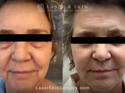 Facelift to rejuvenate the face