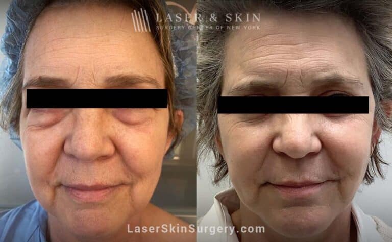 Facelift to rejuvenate the face