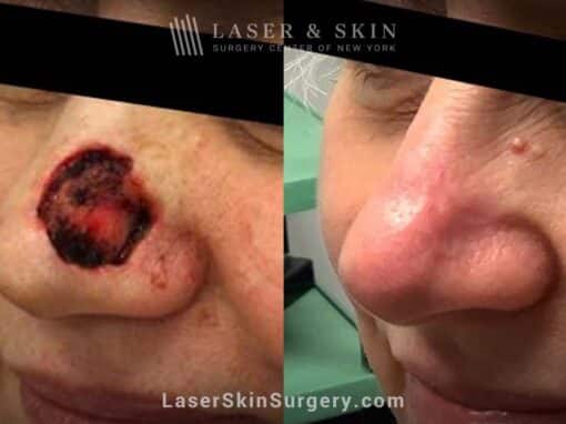 Mohs surgery to remove skin cancer from the nose