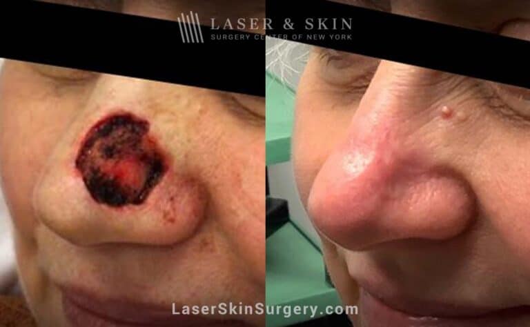 Mohs surgery to remove skin cancer from the nose